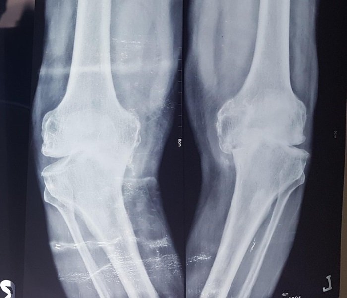 Robotic total Knee Replacement in Mandi HP
